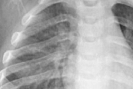 Chlamydia Pneumoniaeの迅速な検出：信頼性と効率的